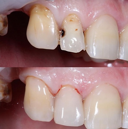 Реставрация зубов (фото до и после)
