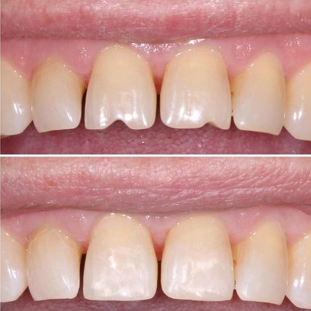 Реставрация (без препарирования) режущего края зубов 