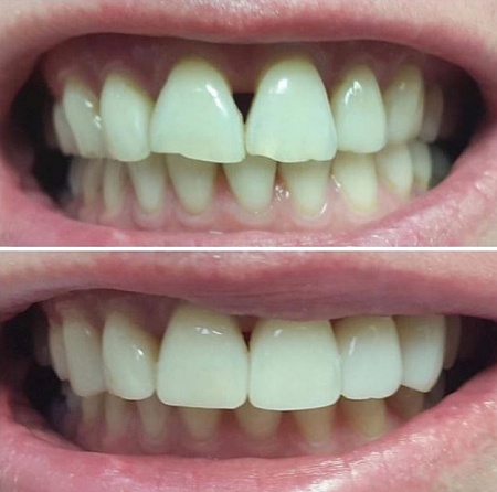 Реставрация двух передних зубов