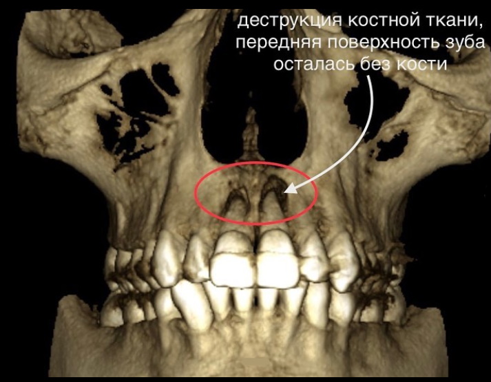 Восстановление костной зубов стоматология авангард томск цены на