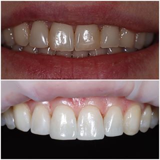 Отбеливание зубов, реставрация композитным материалом