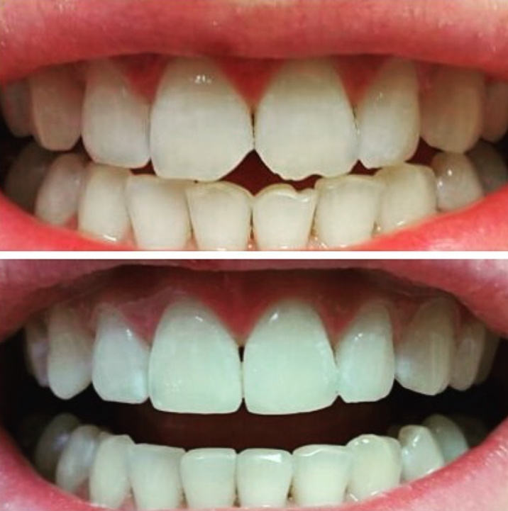 Реставрация зубов Томск Степная 2-я лечение зубов детям в томске под наркозом