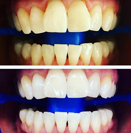 Отбеливание зубов ZOOM (зубы стали светлее на 8 тонов)