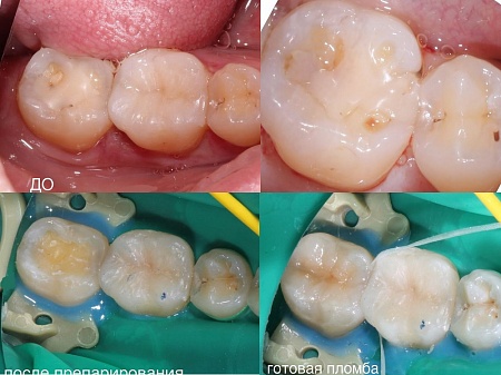  Реставрация на зубе вместо старой пломбы