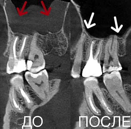 Лечение каналов зуба с помощью микроскопа и ультразвука