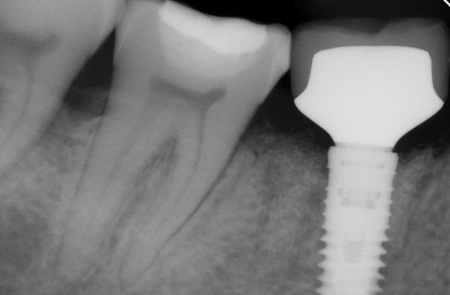 Удаление зуба, имплантация