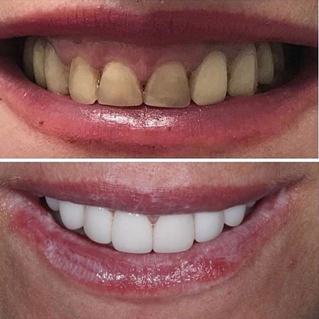 Реставрация передних зубов винирами
