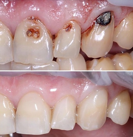 Реставрация зубов (до и после)