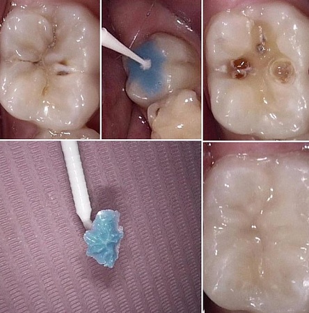 Восстановление формы зуба (метод силиконового ключа)