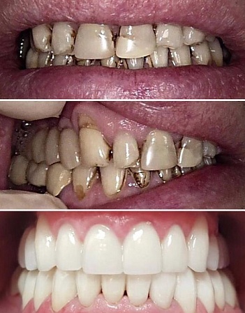 Восстановление всех зубов