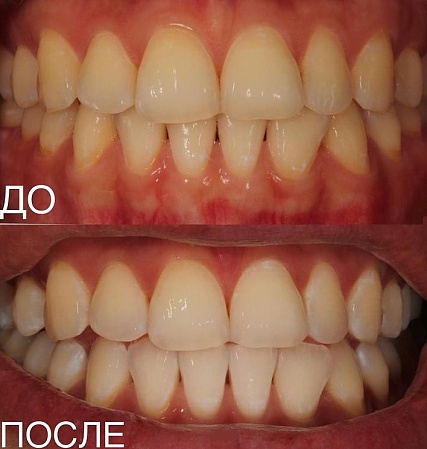 Отбеливание зубов системой ZOOM4