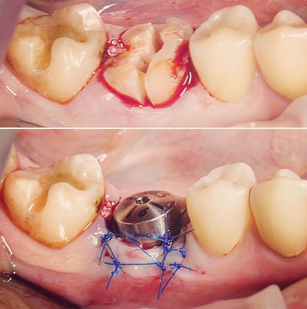 Удаление зуба с одномоментной имплантацией