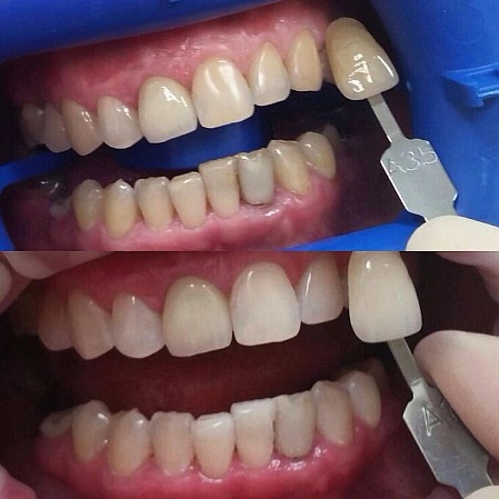 Отбеливание зубов ZOOM (зубы стали светлее на 5 тонов)