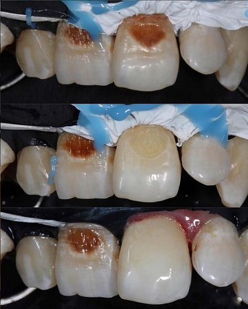 Установка пломбы на фронтальные зубы