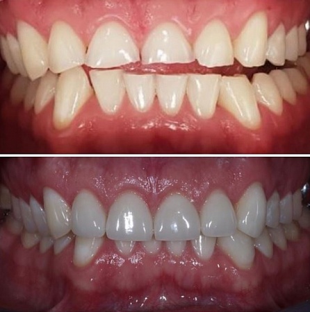 Реставрация зубов верхней челюсти