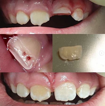 Восстановление сломанного зуба у ребенка