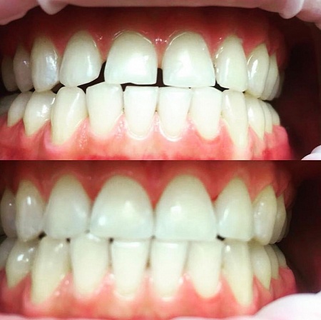  Реставрация зубов светоотверждаемыми, композитными материалами